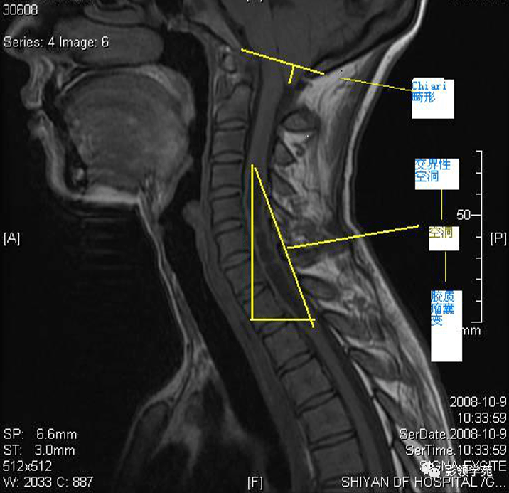 脊髓空洞症影像学表现