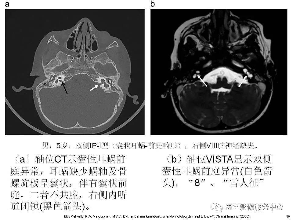 主要基于mri第二部分:内耳畸形分类,主要基于ct第一部分:耳蜗解剖