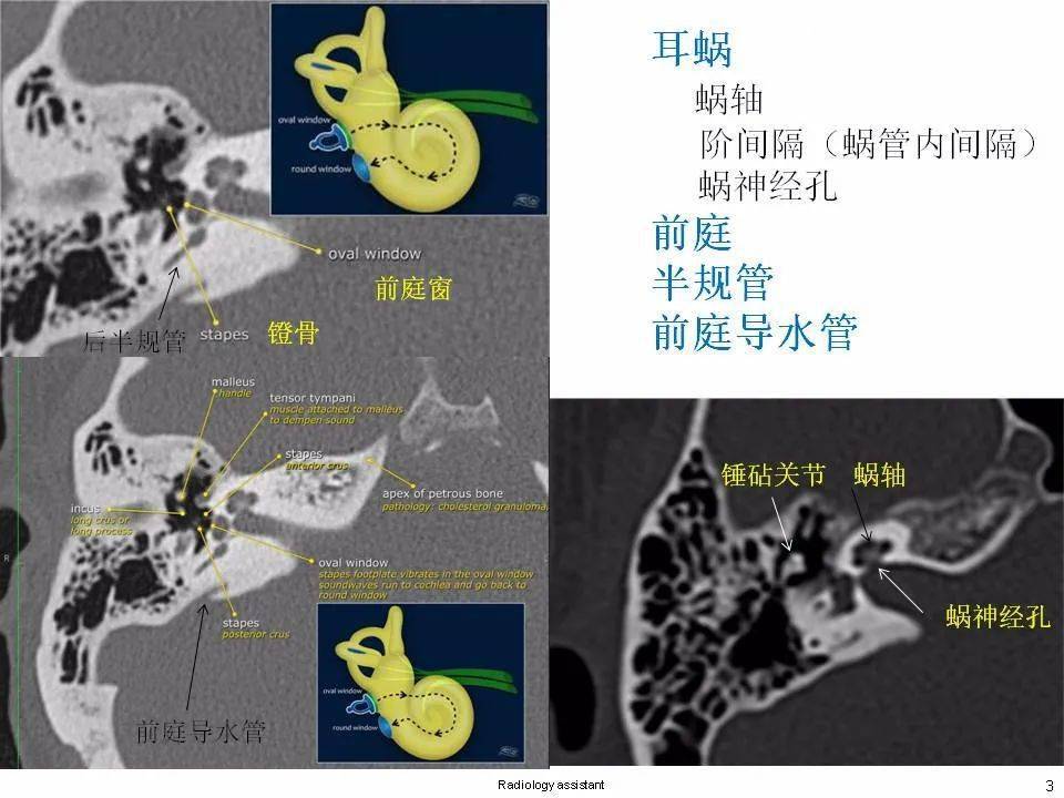 内耳正常解剖及畸形分类