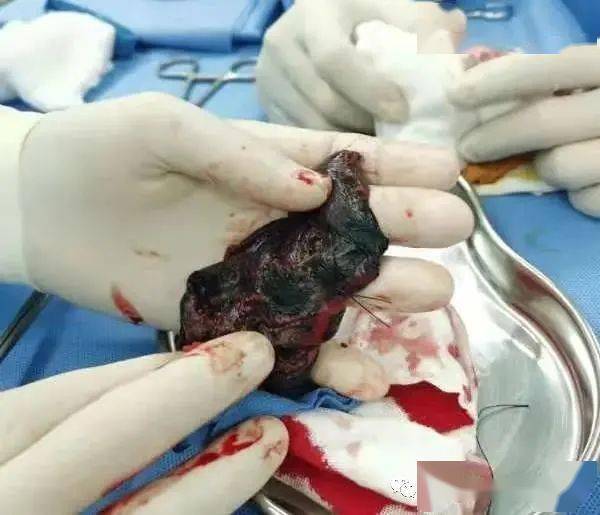 朗开多通道电磁导航支气管镜下肺小结节美兰定位单孔胸腔镜肺段切除术