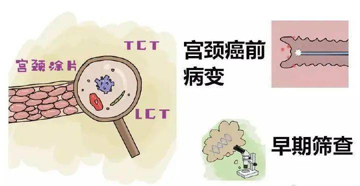 tct(宮頸脫落細胞學)大家對宮頸癌防控的意識逐漸加深近年來,隨著