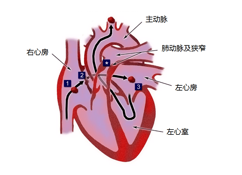 心脏搭脉停博是怎么意思_心脏搭桥是怎么回事