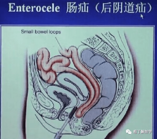 膀胱颈扩张图片