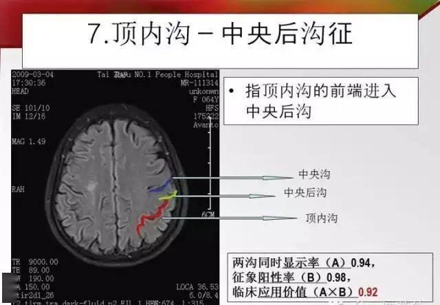 头颅mri横断面脑沟回十大征象