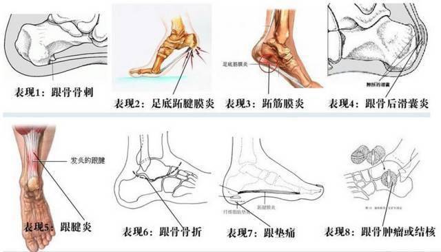 足跟痛 别样的治疗思路 关节炎