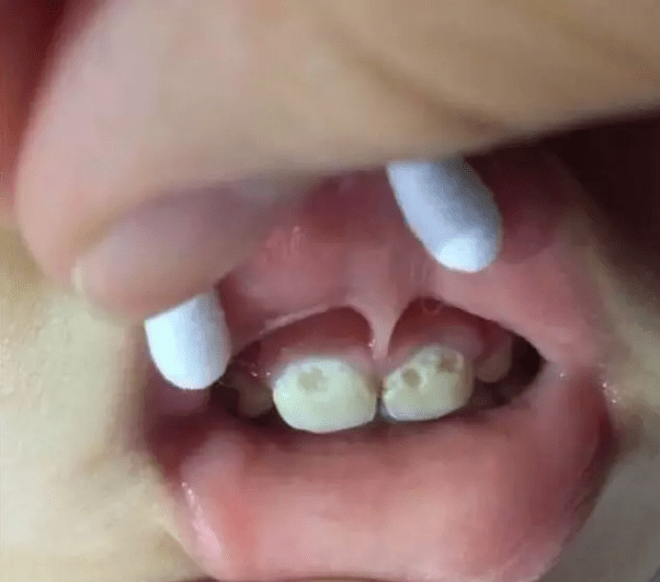4岁男孩满口黑牙全烂光！这些宝宝牙齿问题，现在知道还来得及！