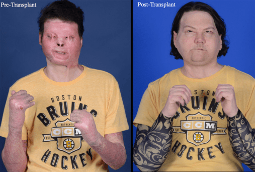 美国一男子罕见同时换脸换手,已学会微笑和眨眼_梅奥