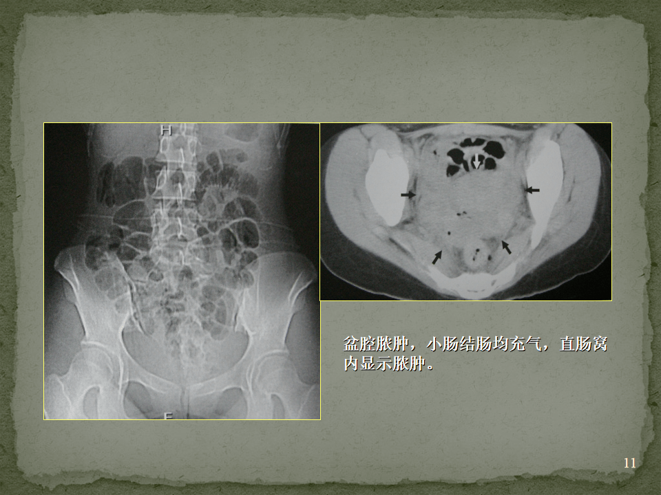 肠梗阻的影像学表现图片