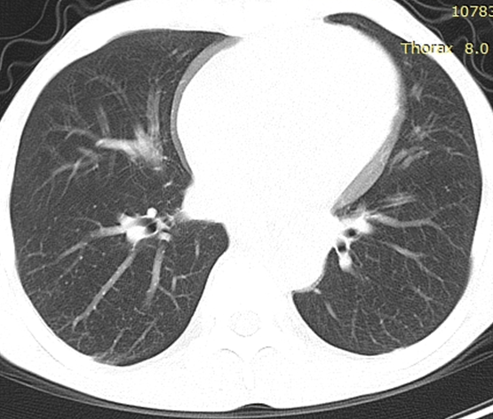 摸象之认识正常的肺野透过度