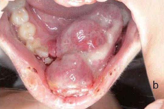 孕期牙龈息肉照片图片