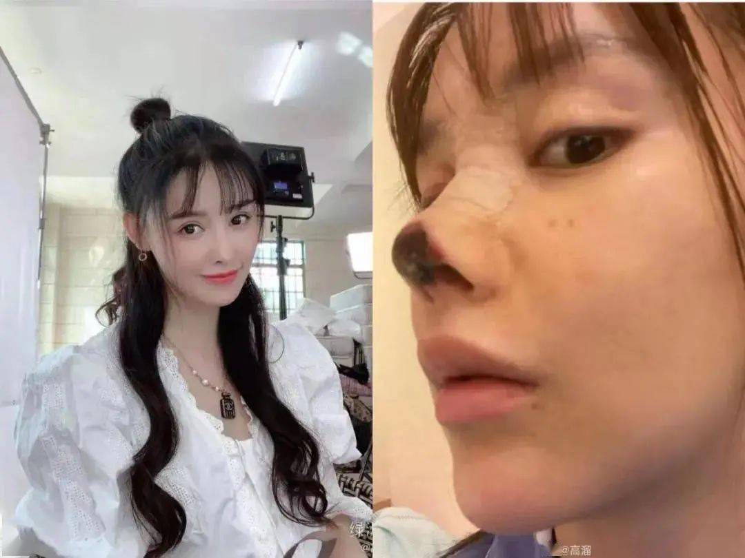 女演员自曝整容失败鼻尖坏死家有女儿请告诉她长大整容不如整容式长大