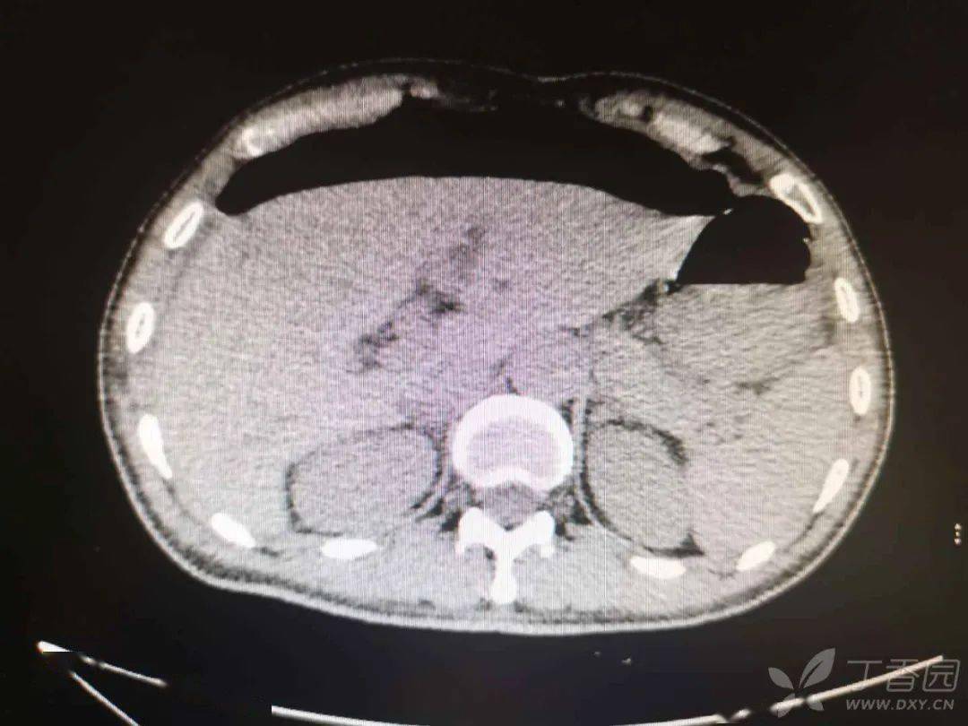 形形色色的消化道穿孔,坑真多![收藏]