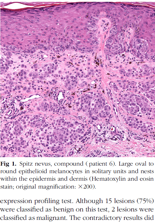 老年人的spitz痣组织病理学与基因表达谱分析结果的相关性