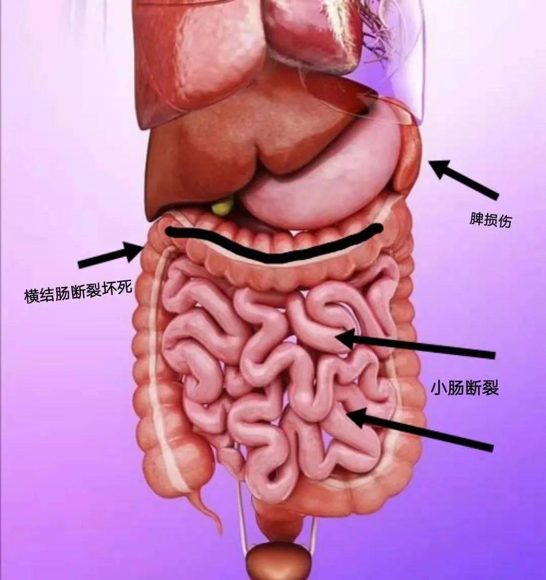 横结肠疼痛位置图图片