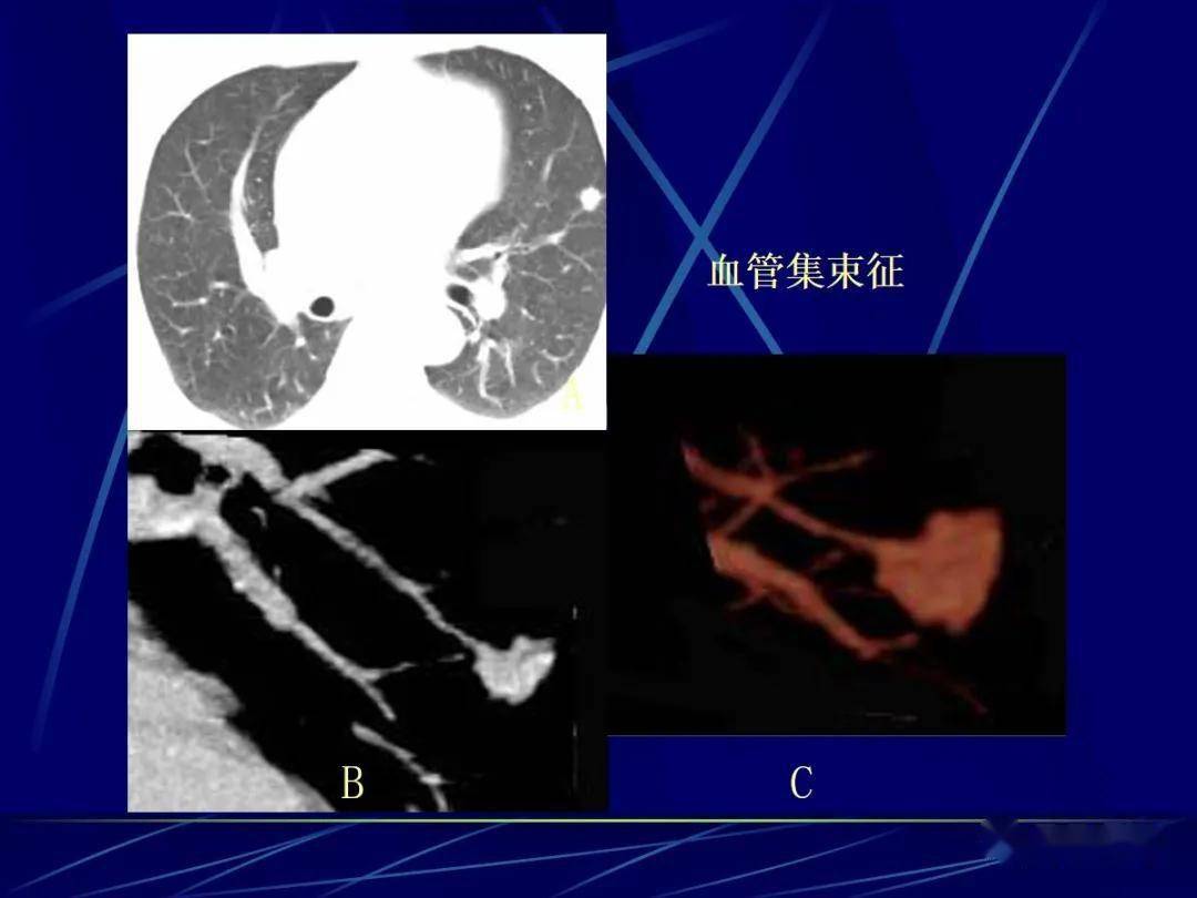 空泡徵支氣管徵和空泡徵指線狀,分支狀氣體影或小空泡,在多層螺旋ct