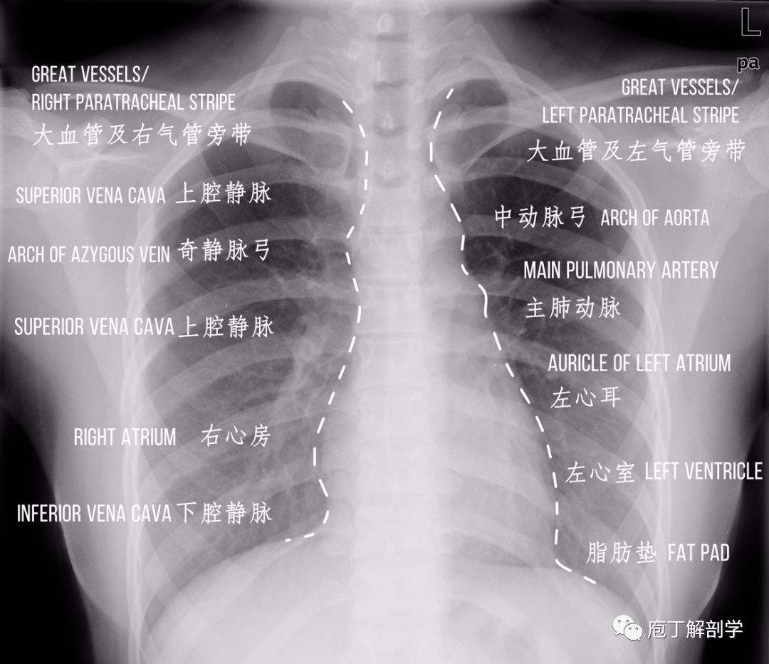 教你如何看肺炎胸片图片