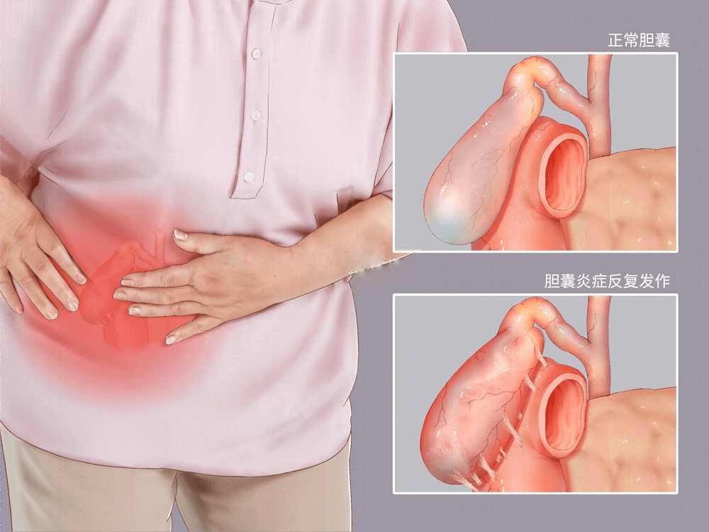 胆囊炎疼痛位置图图片