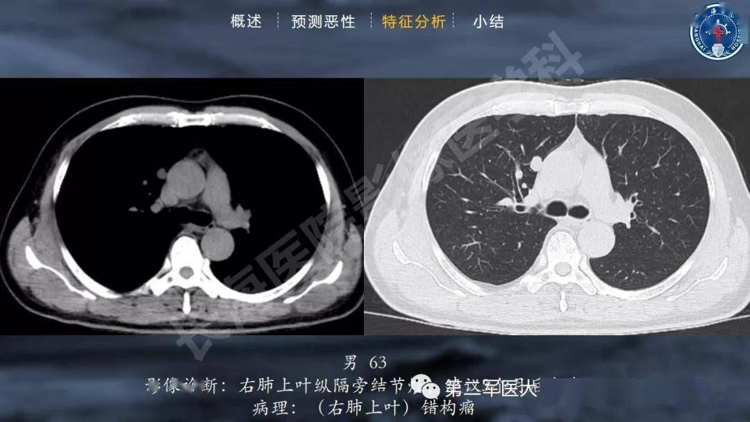 實性肺結節的良惡性ct徵象解析