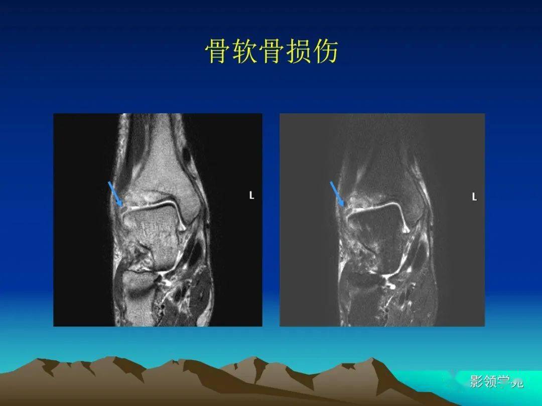 脂肪间隙及关节腔异常变化 邻近组织,结构的异常改变:骨折,骨挫伤,骨