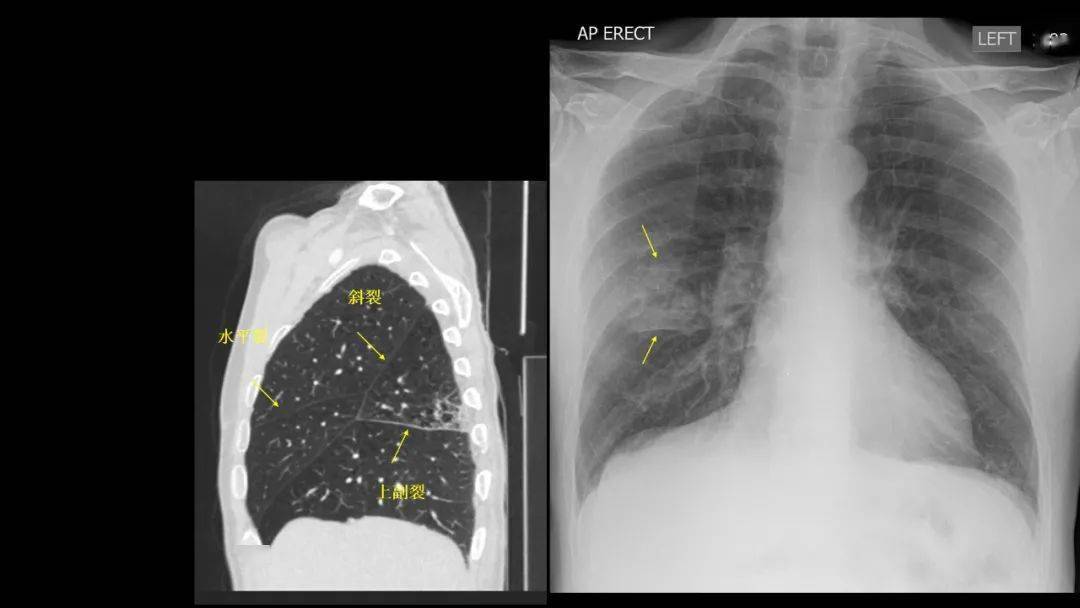 右肺叶间裂CT示意图图片