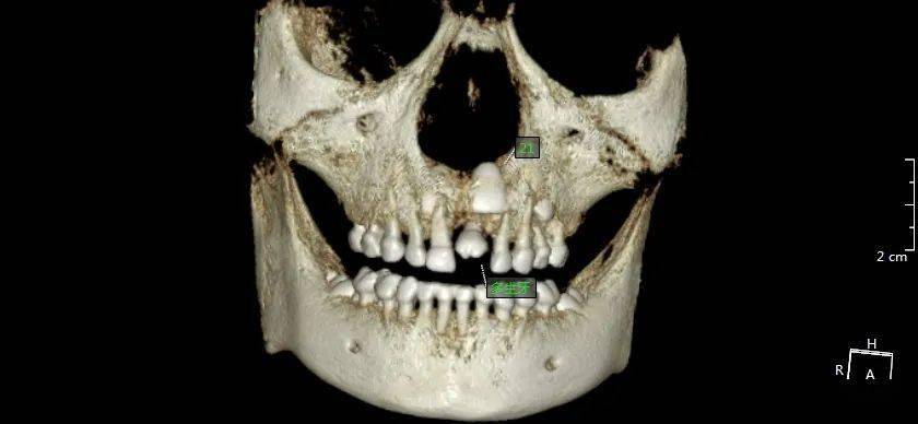 ct示:61缺失,此位置可見一正位畸形多生牙,位於21牙胚的唇側.