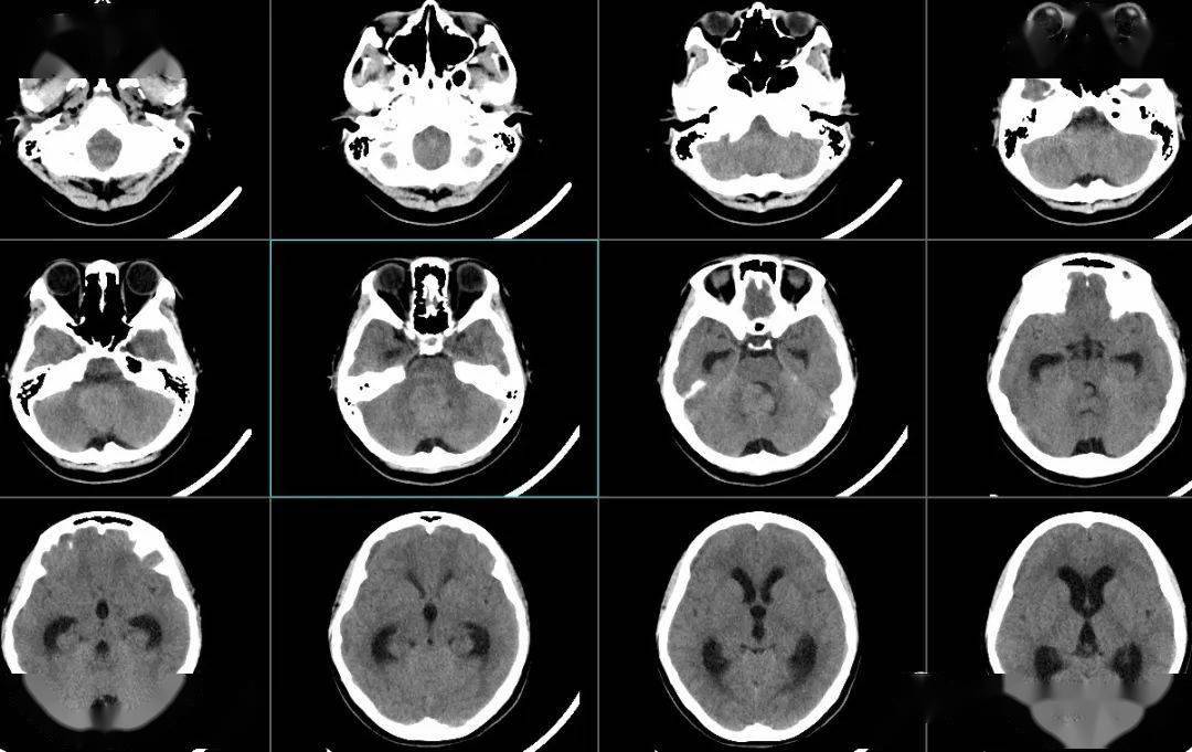 小腦蚓部及四腦室見團塊狀稍高密度影,大小約41×33mm,邊界清,未見