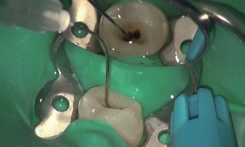 与次氯酸钠和edta相比70乙醇冲洗根管封药更有效最近的研究