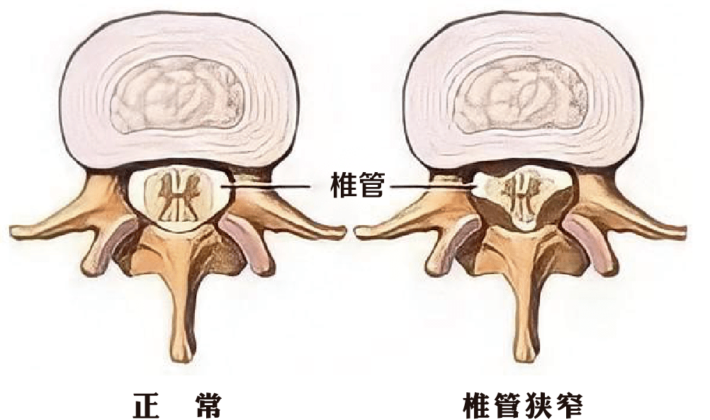 前沿的脊柱微创技术ube技术让老人迈开了步