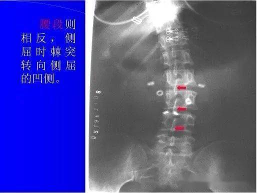 脊椎右旋与人类脊椎病的起源_手机搜狐网