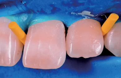 复合树脂微创美学修复——前牙的修复