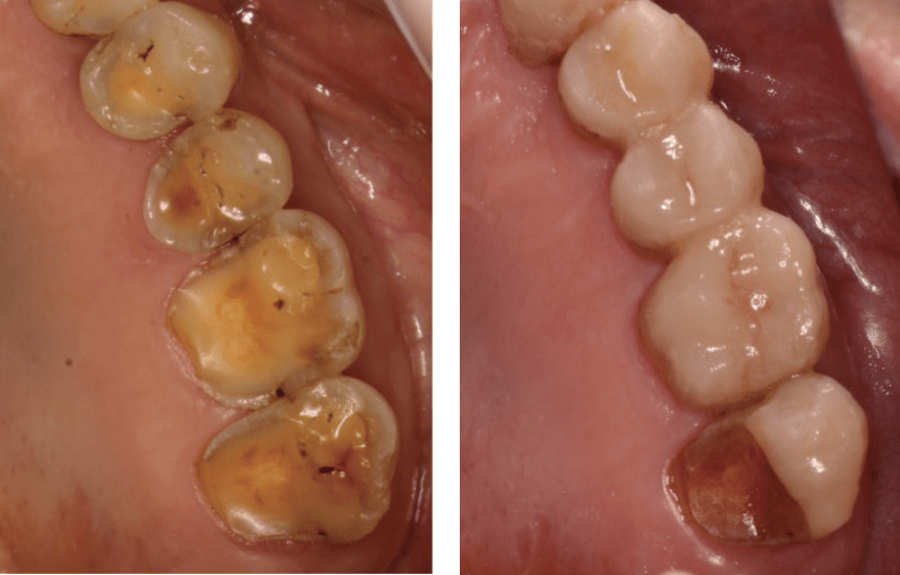 临床先锋粘接修复的失败和提示姜婷教授