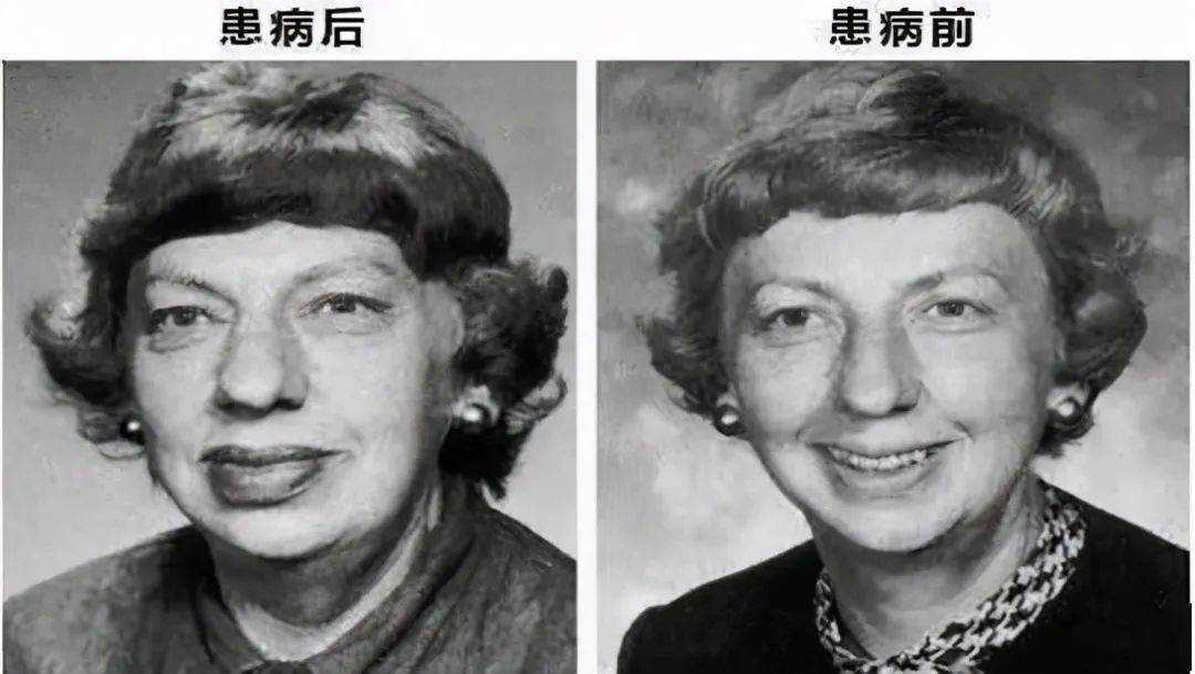 小小脑垂体瘤,当心惹出大麻烦_手术
