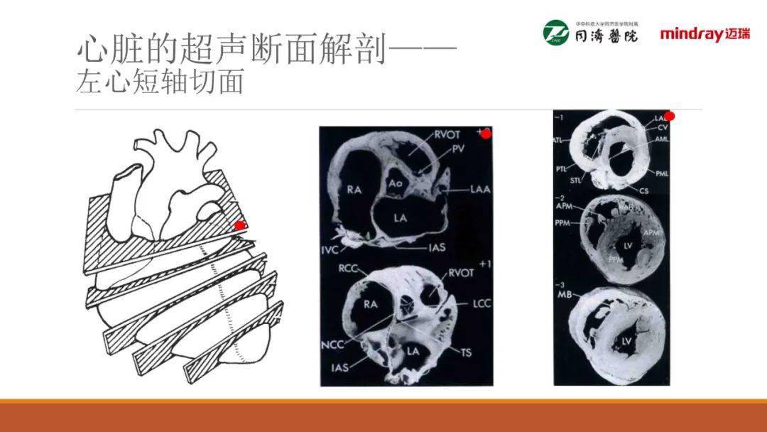 武汉同济医院麻醉科围术期经胸超声心动图tte