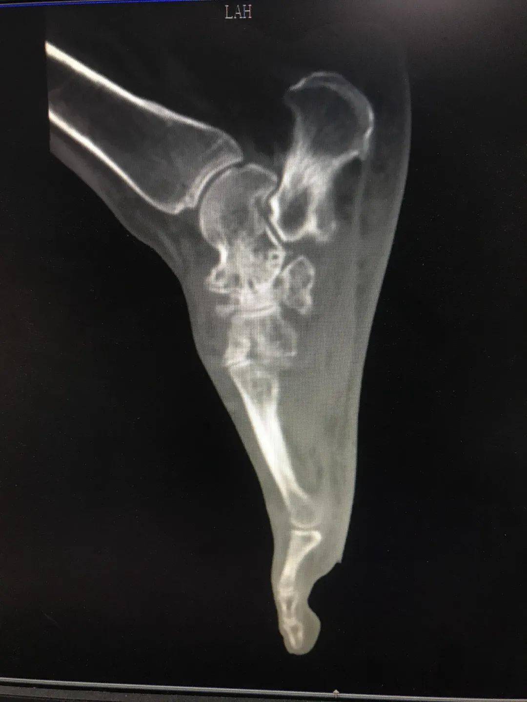 "莫非是muller-weiss?