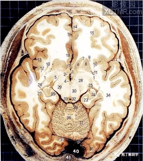 有髓神经纤维横断面图片