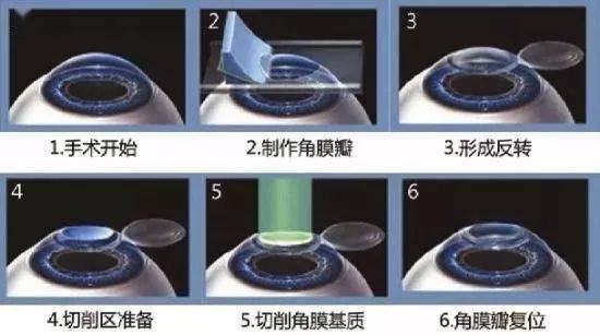 近视激光手术原理图片