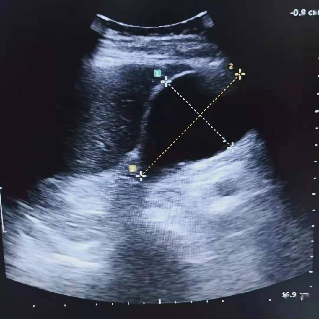 ct及超声下极度扩张的胆囊果然是急性化脓性胆囊炎导致的感染性休克!