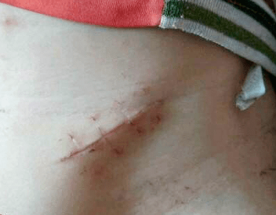女性结扎的伤口图片图片