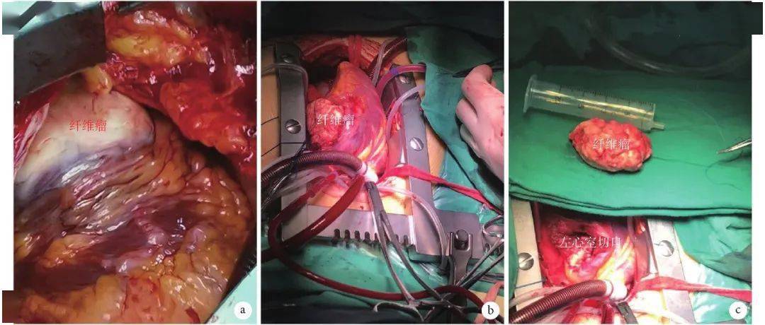 心脏得了肿瘤是什么样子这篇病理分析你一定要看