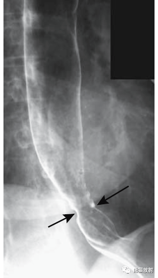 食管静脉曲张造影图片