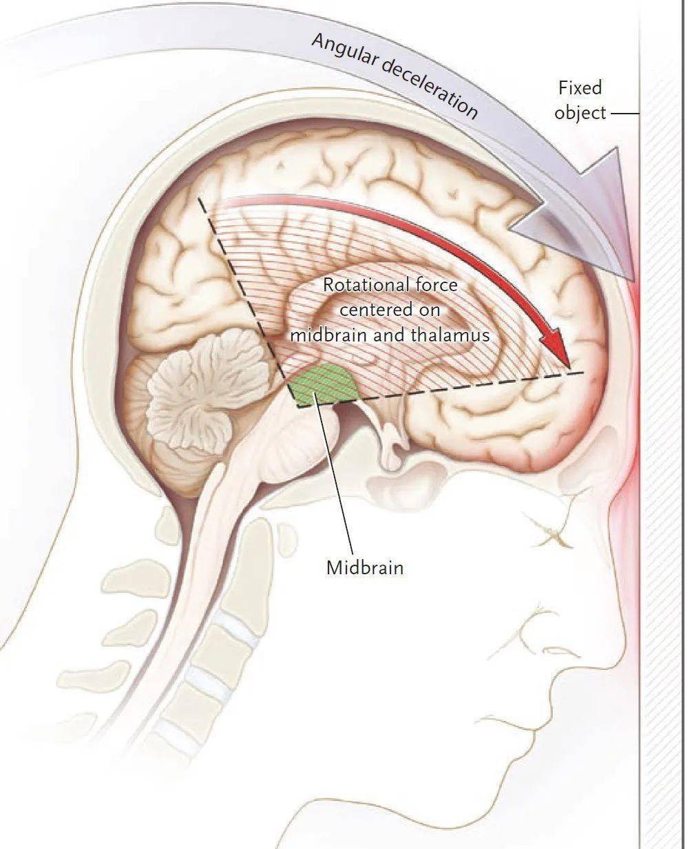 这种损害与上脑干的机械性旋转角切力,颅脑损伤时脑脊液的冲击(脑室液