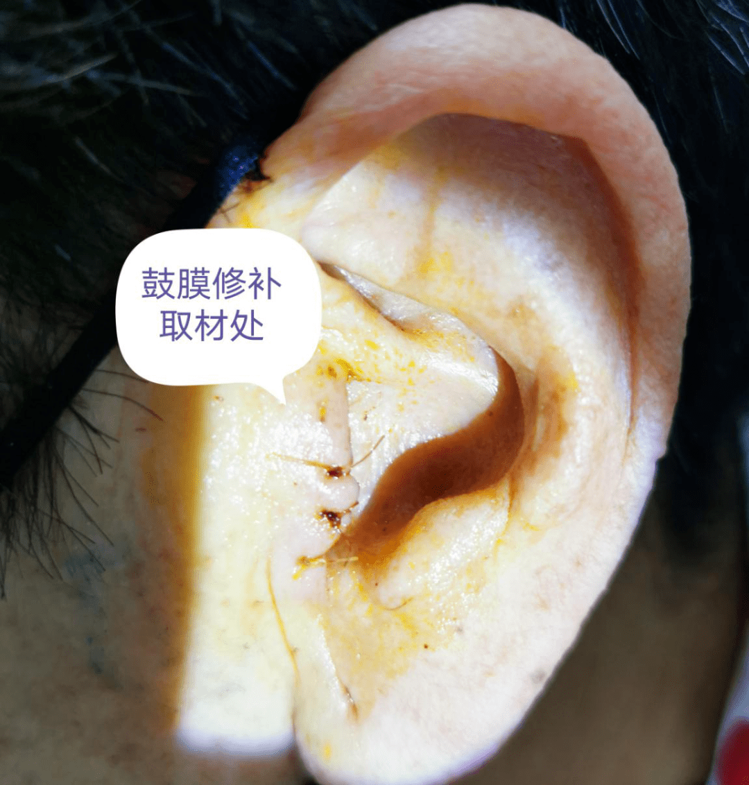 人工听骨形状图片