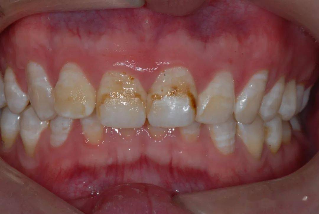 氟斑牙白垩型图片