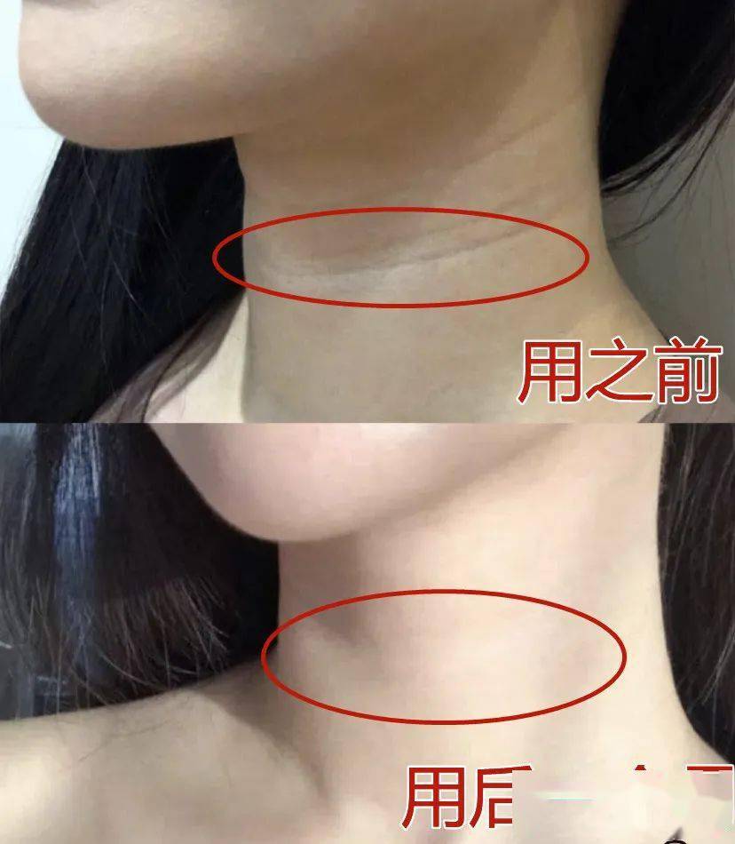 怎么瘦下巴与脖子颈纹 77079fc7526c4226bd31bf9834029c45.jpeg