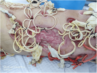 跨年战役团队协作战胜坏死性筋膜炎图片真实胆小慎入