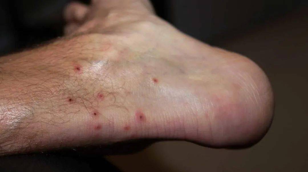 "人间最惨烈的臭虫攻击",这个新西兰游客的体验是普遍现象吗?_dave