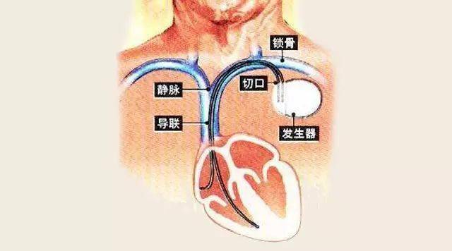 日本起搏器百万人口植入量_心脏起搏器图片