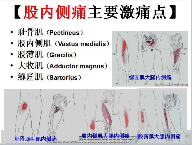 足弓及足中部痛主要激痛点腓肠肌(gastrocnemius)趾长屈肌(flexor