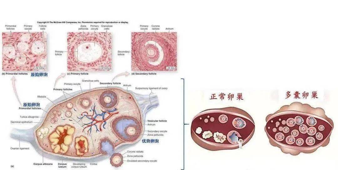 多囊卵巢綜合徵(pcos)與子宮內膜病變的關係_激素