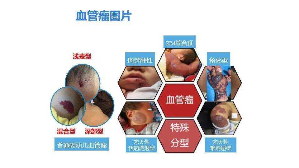 婴幼儿血管瘤诊治趋势与最新研究进展
